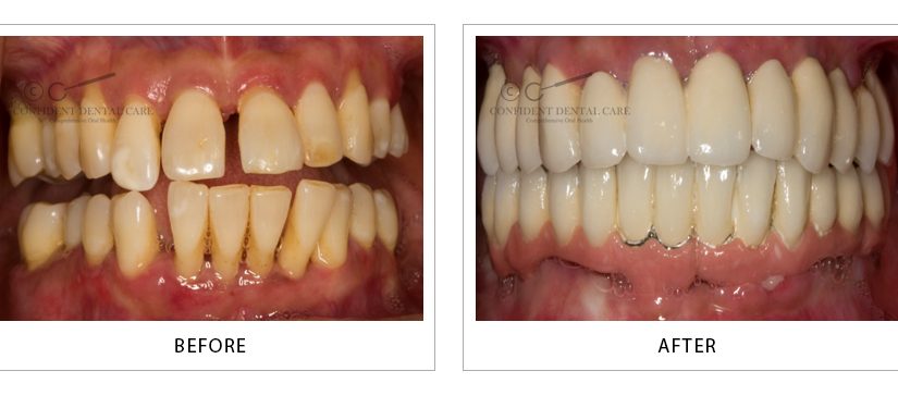 Full Mouth Implant