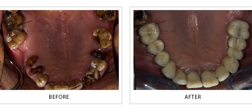 Full Mouth Implant