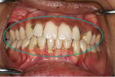 Periodontics Before Treatment