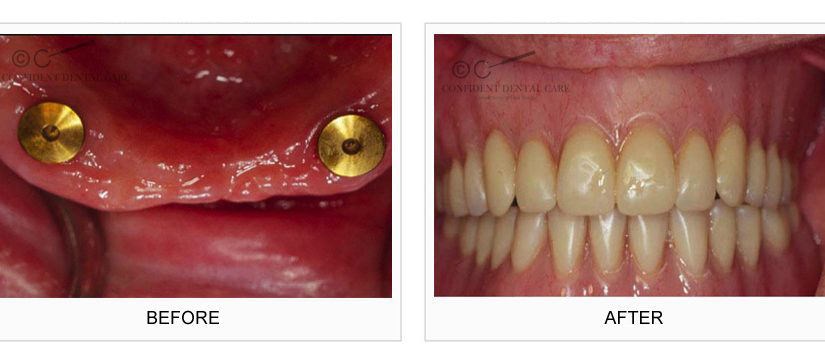 Implant Support Denture