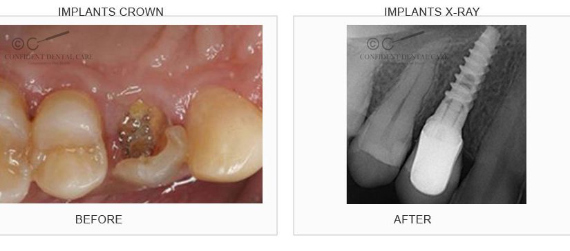Implant Crown
