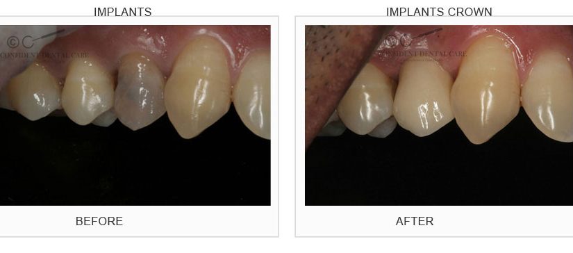 Implant Crown