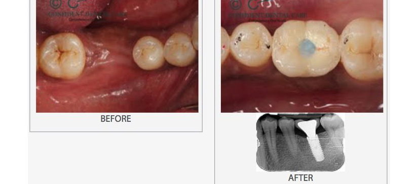 Implant Crown