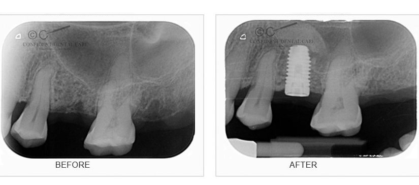 Implants X-Ray