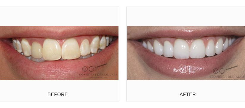 Smile Designing