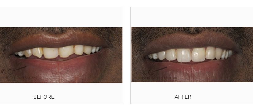 Smile Designing