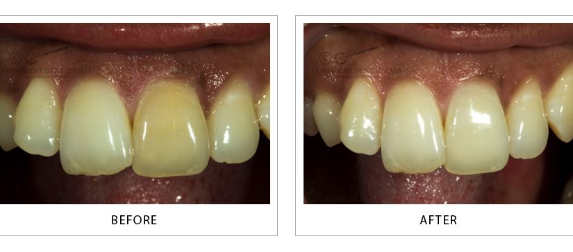 Teeth Whitening & Bleaching
