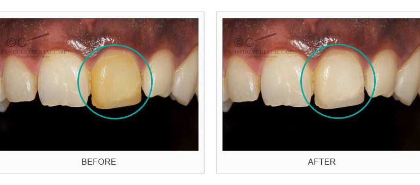 Teeth Whitening & Bleaching