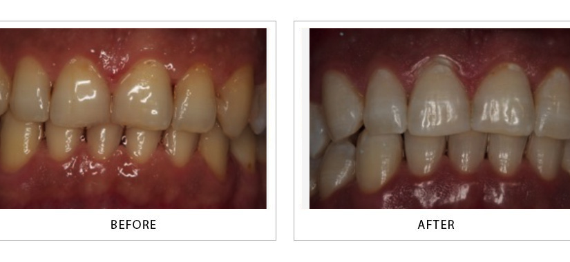 Teeth Whitening & Bleaching