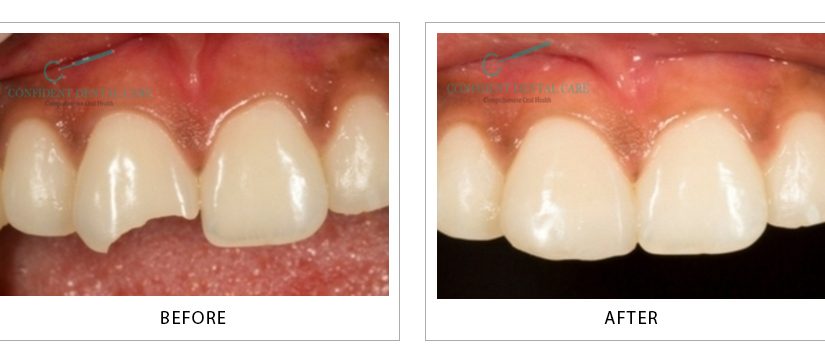 Tooth Color Fillings (Composite)