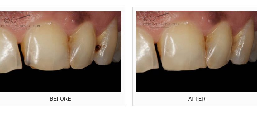 Tooth Color Fillings (Composite)