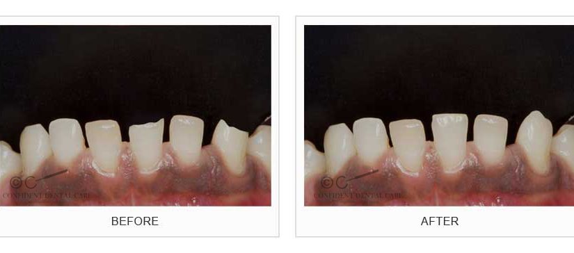 Tooth Color Fillings (Composite)