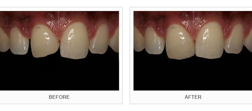 Tooth Color Fillings (Composite)