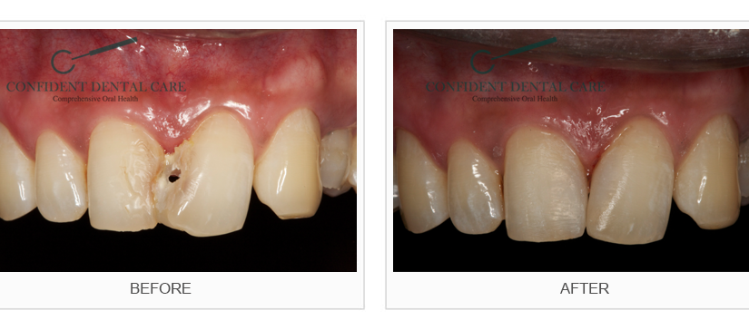 Tooth Color Fillings (Composite)