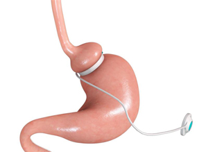 Gastric Band Adjustments & Removal