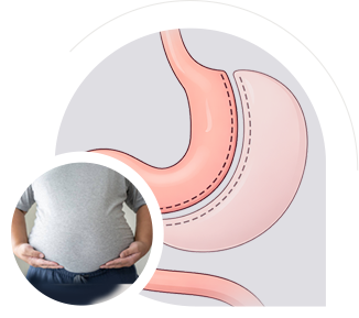 Sleeve Gastrectomy img