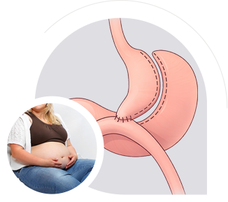 One Anastomosis Gastric Bypass img