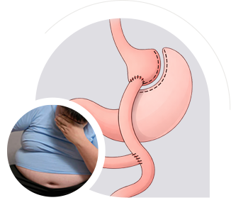 Roux-en-Y Bypass img