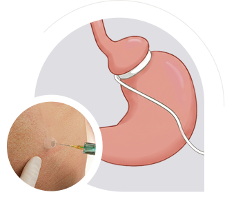 Gastric Band Adjustments & Removal img
