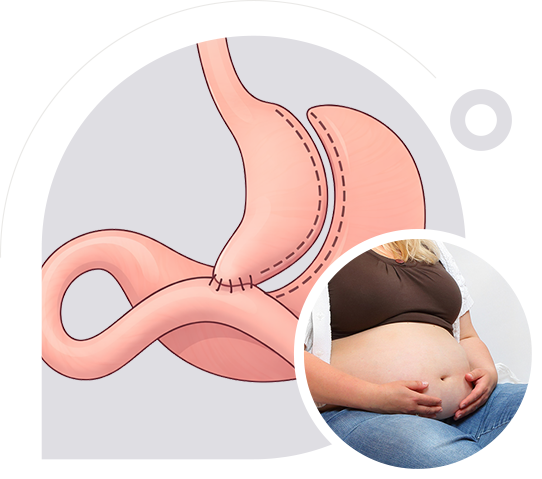 One Anastomosis Gastric Bypass img