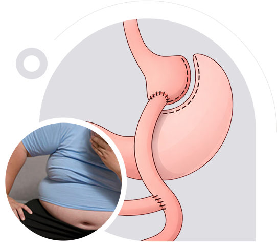 Roux-en-Y Bypass img