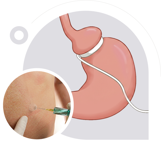 Gastric Band Adjustments & Removal img