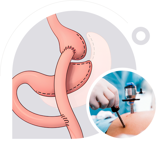 Revisional Surgery img