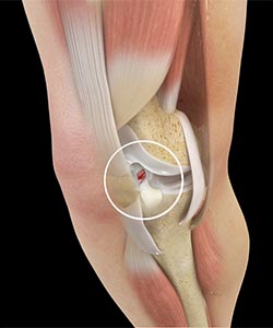 ACL Tears