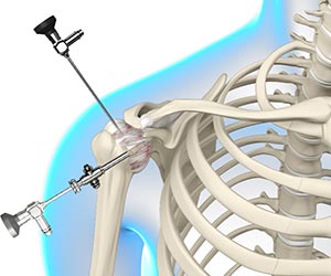Arthroscopic Frozen Shoulder Release