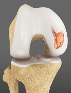 Articular Cartilage Injury