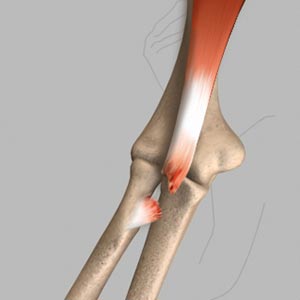 Biceps Tendon Tear at the Elbow