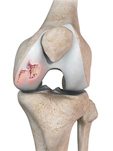 Chondral or Articular Cartilage Defects