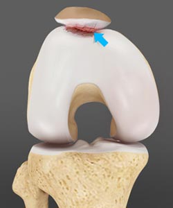Chondromalacia Patella