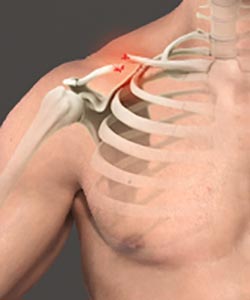 Clavicle Fracture