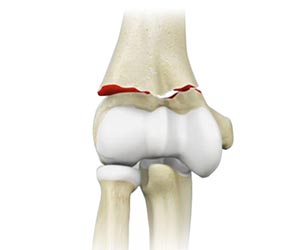 Elbow Fractures