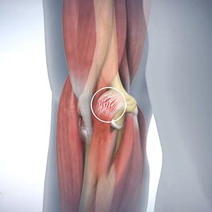 Golfer's Elbow