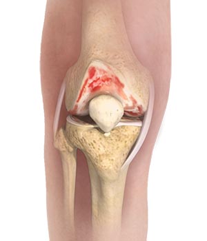 Knee Osteoarthritis