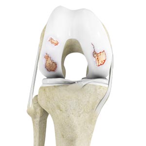 Osteoarthritis