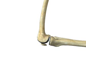 Partial Knee Replacement