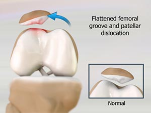 Patellar Dislocation/Patellofemoral Dislocation