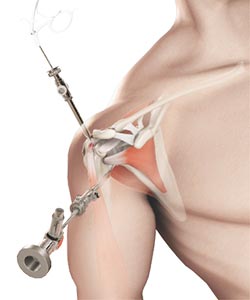 Shoulder Arthroscopy
