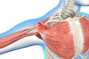Shoulder Impingement