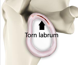 Shoulder Labral Tear