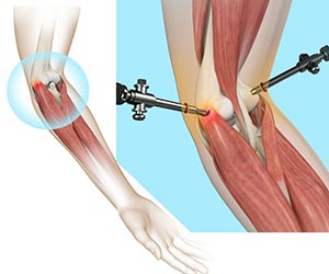 Tennis Elbow Surgery