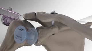 AC Joint Repair with Arthrex<sup>®</sup> Dog Bone<sup>™</sup> Button Videos