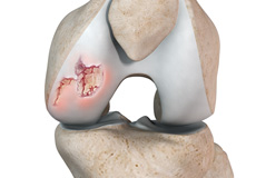 Cartilage defects and cartilage restoration of the knee and shoulder