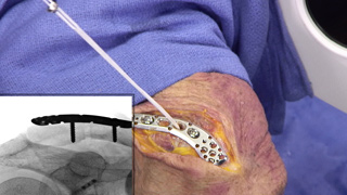 Distal Clavicle Fracture Videos