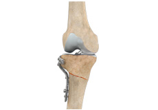 Femoral and tibial osteotomy