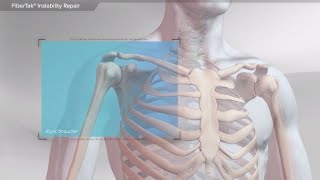 FiberTak<sup>®</sup> Instability Repair Videos