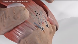FiberTak<sup>®</sup> DR Anchor Bridge Technique Videos